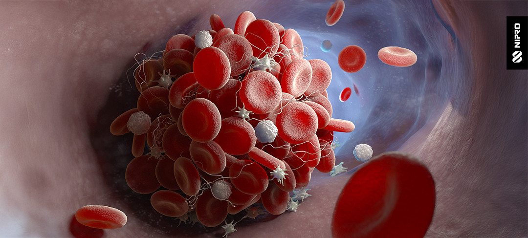 Blood clot and emboli